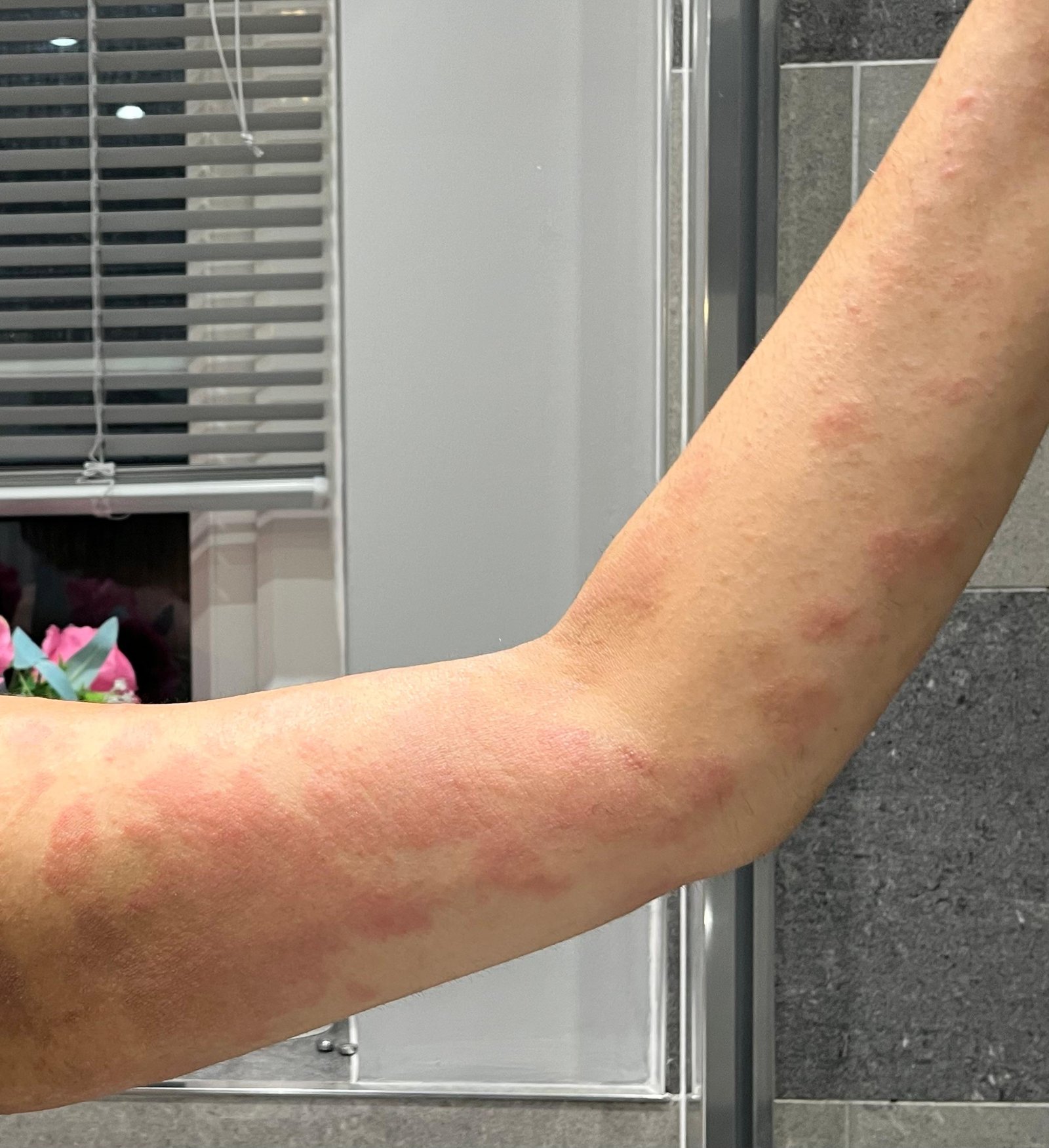 The device measures the changes in the material in each layer of the skin using small vibrations on the surface to detect tissue stiffness and change in fluids.