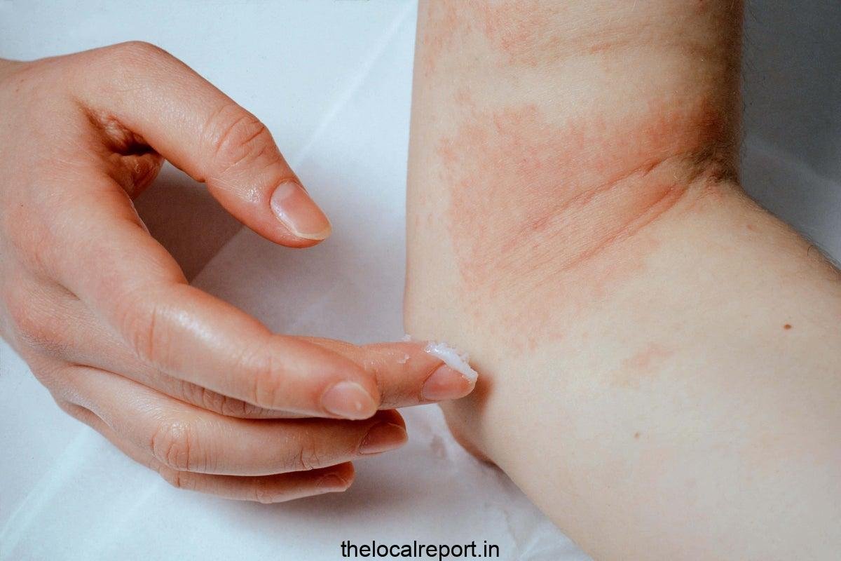 Millions of patients can benefit from the new eczema tool