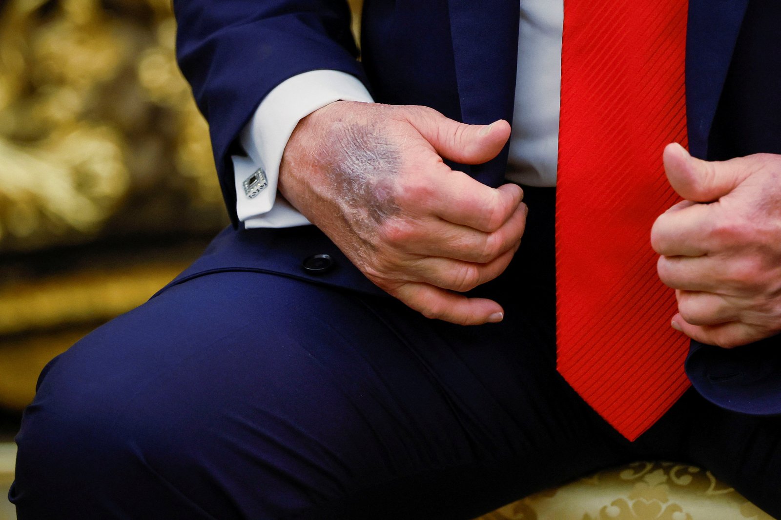 There has been speculation about the health of the President due to frequent injury to his hand.