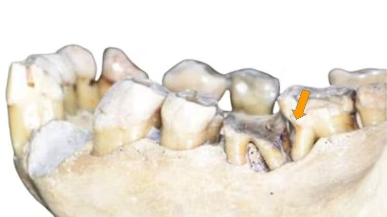 Orangutan (Pongo Pygames) with a 'toothpick groove' on the lower left second molar