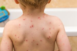Chickenpox vaccine: How and where to offer children free vaccination as NHS rollout begins