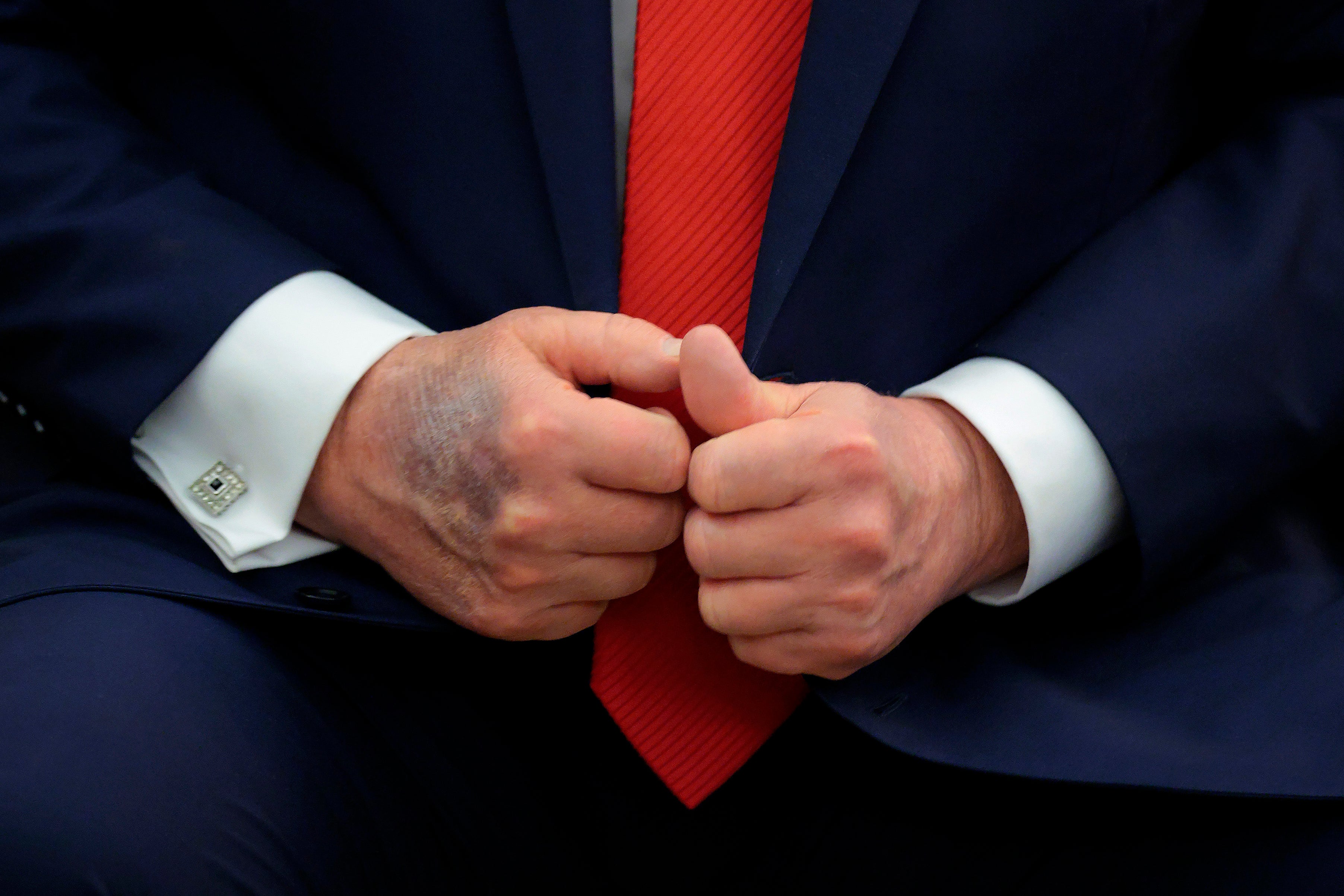 Trump attributes bruise on right hand to frequent handshakes and taking aspirin