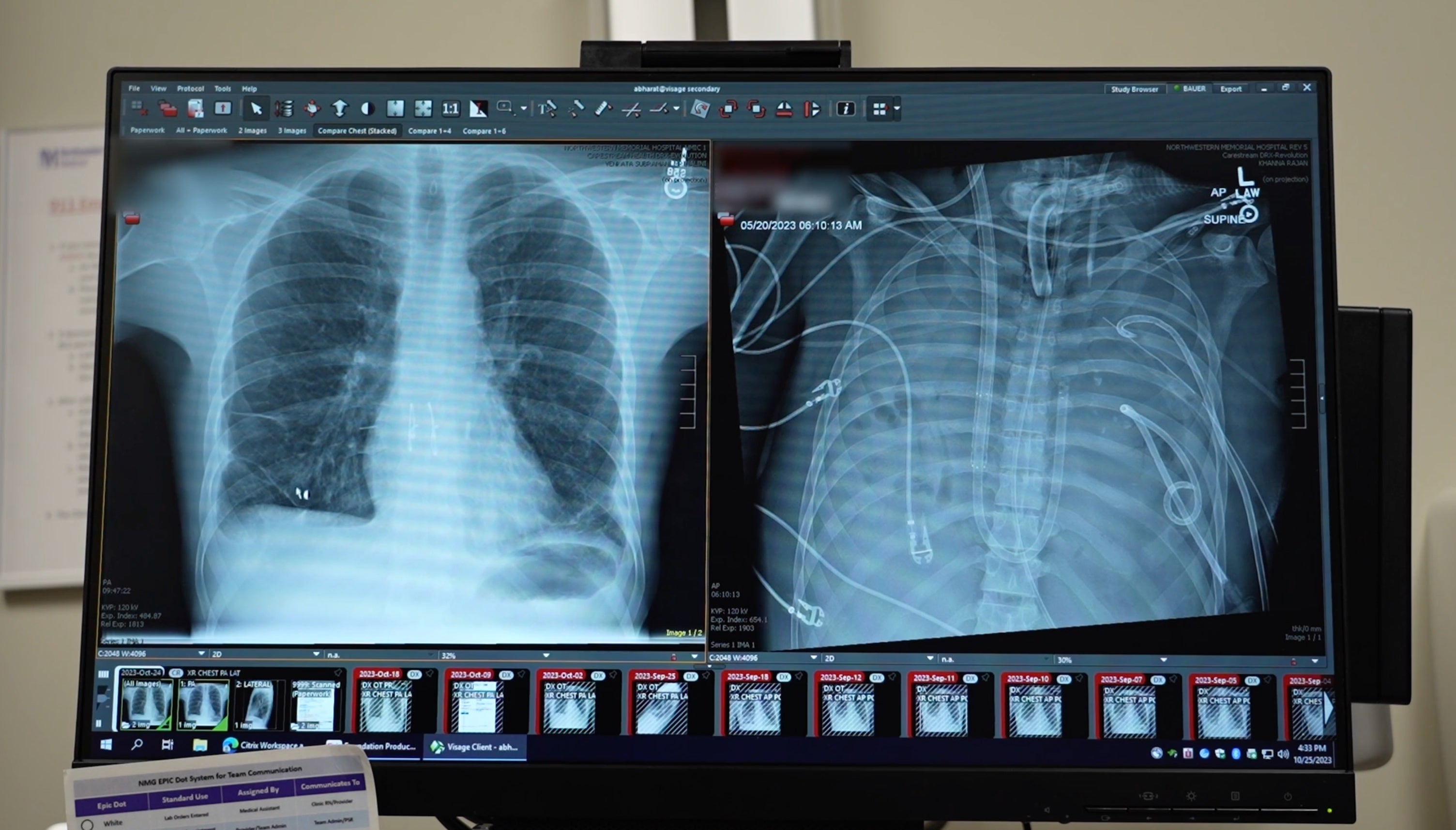 The patient's new lung (left) and old lung (right)