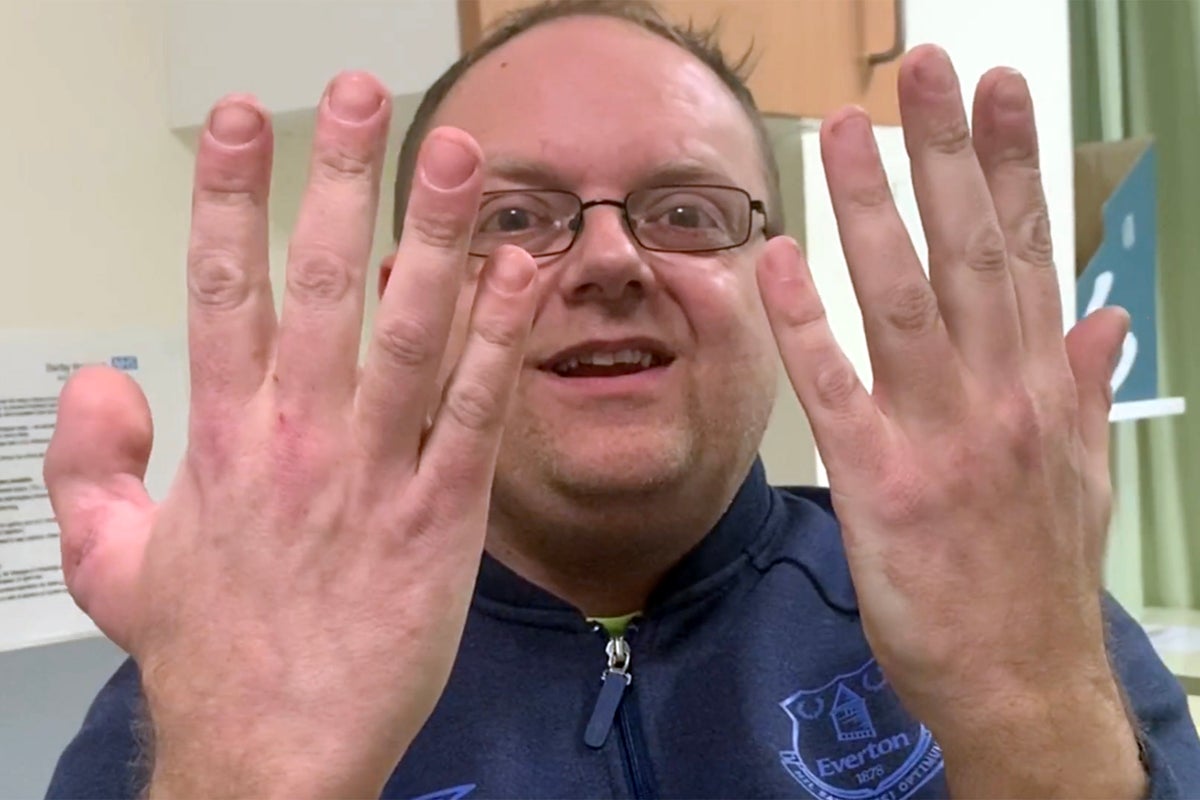 "I need bigger gloves because my thumb is my big toe"