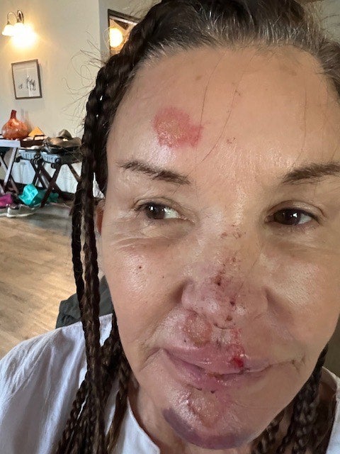 Janice Dickinson claims she suffered facial injuries while taking part in reality show I'm a Celebrity South Africa