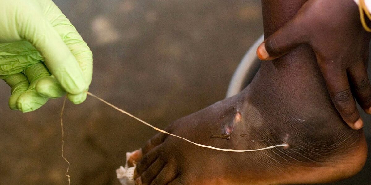 World getting closer to eradicating human Guinea worm cases, just 10 last year: Carter Center