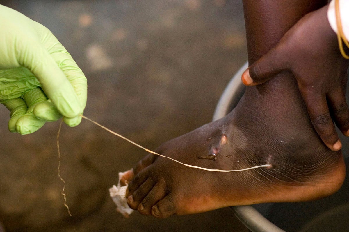 World getting closer to eradicating human Guinea worm cases, just 10 last year: Carter Center